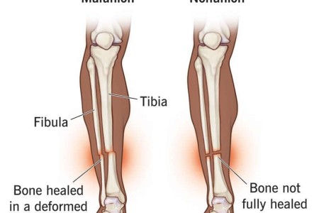 Malunion & Nonunion Fractures