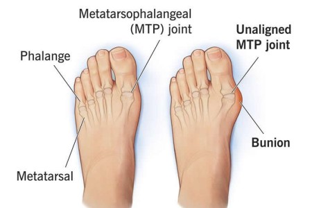 Bunions (Hallux Valgus)