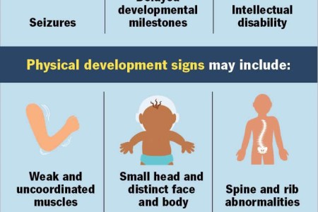 Aicardi Syndrome
