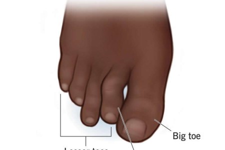 Hammertoes