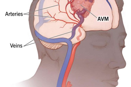 Arteriovenous Malformation