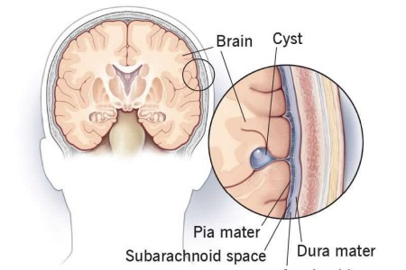 Arachnoid Cysts