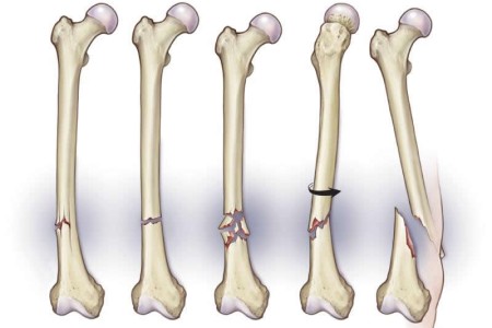 Bone Fractures