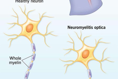 Neuromyelitis Optica (NMO)