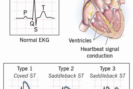 Brugada Syndrome