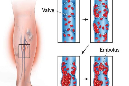 Deep Vein Thrombosis (DVT)