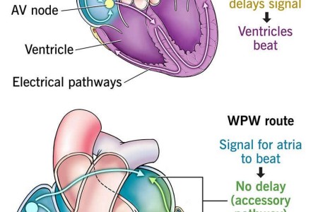 Wolff-Parkinson-White Syndrome