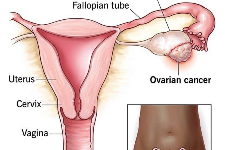 Ovarian Cancer