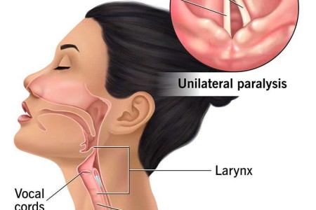 Vocal Cord Paralysis