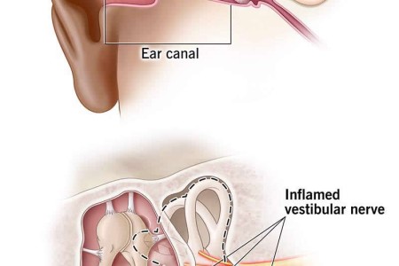 Vestibular Neuritis