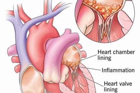 Endocarditis
