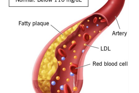 High Cholesterol in Children