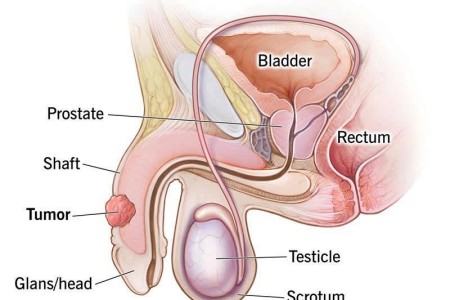 Penile Cancer