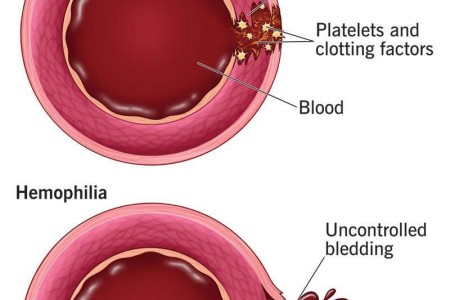 Hemophilia