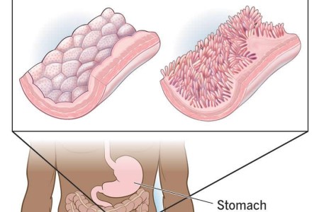 Celiac Disease