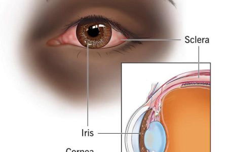 Uveitis