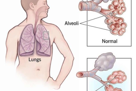 Emphysema
