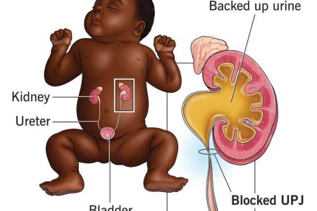 Ureteropelvic Junction Obstruction