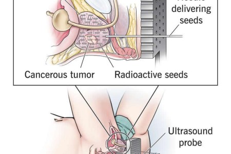 Brachytherapy for Prostate Cancer