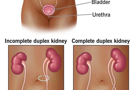 Duplex Kidney (Duplicated Ureters)
