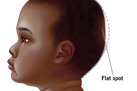 Plagiocephaly (Flat Head Syndrome)