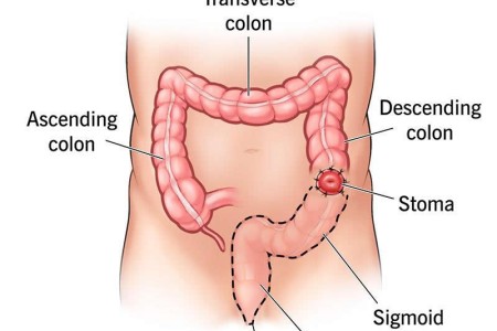 Abdominoperineal Resection (APR Surgery)