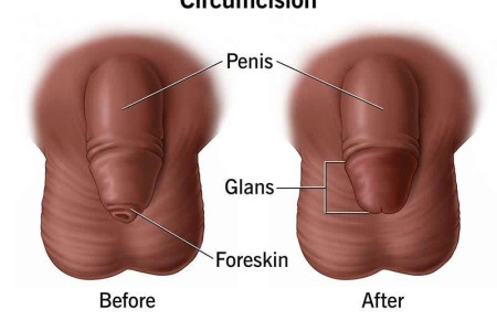 Circumcision