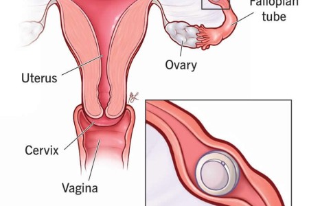 Ectopic Pregnancy