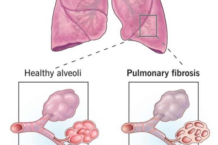 Pulmonary Fibrosis