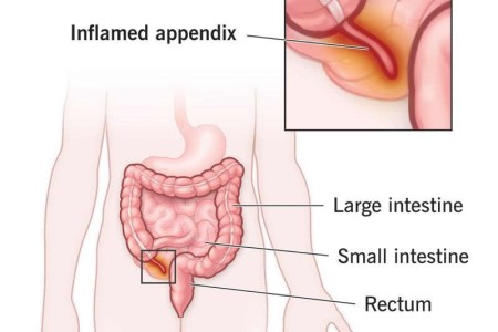 Appendicitis