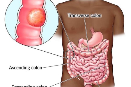 Colorectal (Colon) Cancer