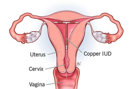 ParaGard® (Copper IUD)