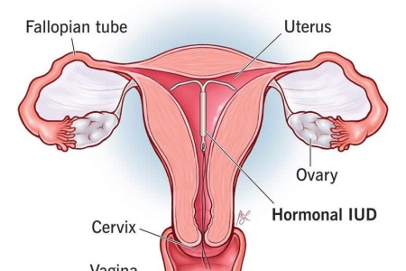 Hormonal IUD