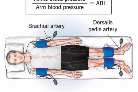 Ankle-Brachial Index (ABI)