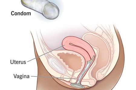 Internal Condom