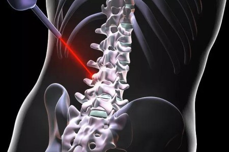 Can Laser Spine Surgery Fix Your Back Pain?
