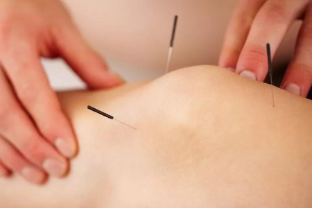 Need Pain Relief? Try Acupuncture Instead of Opioids