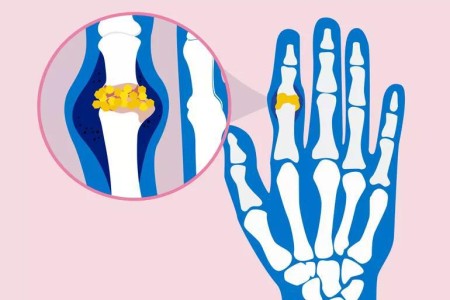 Can You Get Gout in Your Hands?