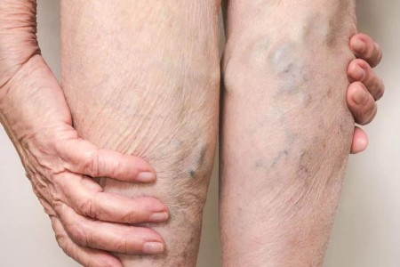 Why Big, Blue Varicose Veins Raise a Red Flag