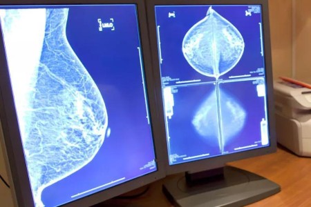 My Biopsy Shows I Have Pseudoangiomatous Stromal Hyperplasia (PASH) ― Now What?