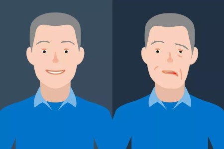 Bell’s Palsy: How to Recover From This Puzzling Facial Paralysis