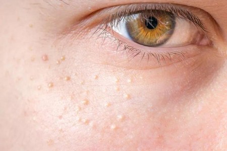 Does Your Skin Have Tiny White Bumps? Leave Them Alone