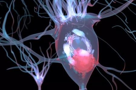 5 Symptoms of Lewy Body Dementia