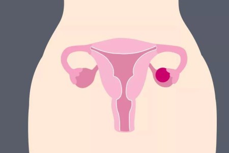 When an Ovarian Cyst Ruptures: Is It an Emergency?