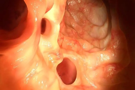 How Do You Treat ‘Smoldering Diverticulitis?’