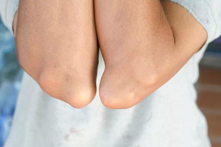 Gout Attacks? Here’s Why You Might Want to Consider Medication to Lower Your Uri