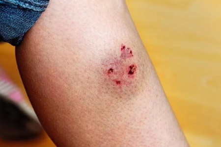 If a Dog Bites You, Do These 7 Things Now