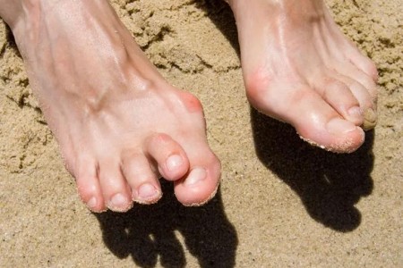 5 Things You Should Know About Hammertoe and Other Painful Toe Deformities