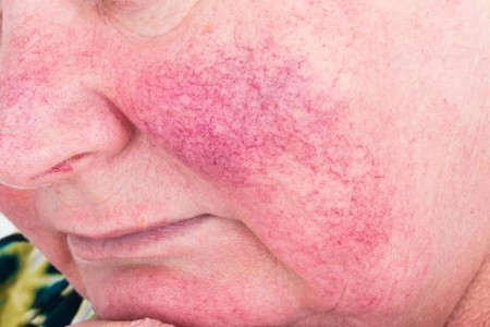 Are Mystery Triggers Causing Your Rosacea Flare-ups?