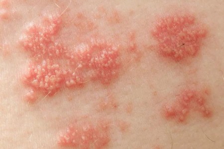 Burning, Lingering Pain After Shingles? 5 Options May Help You